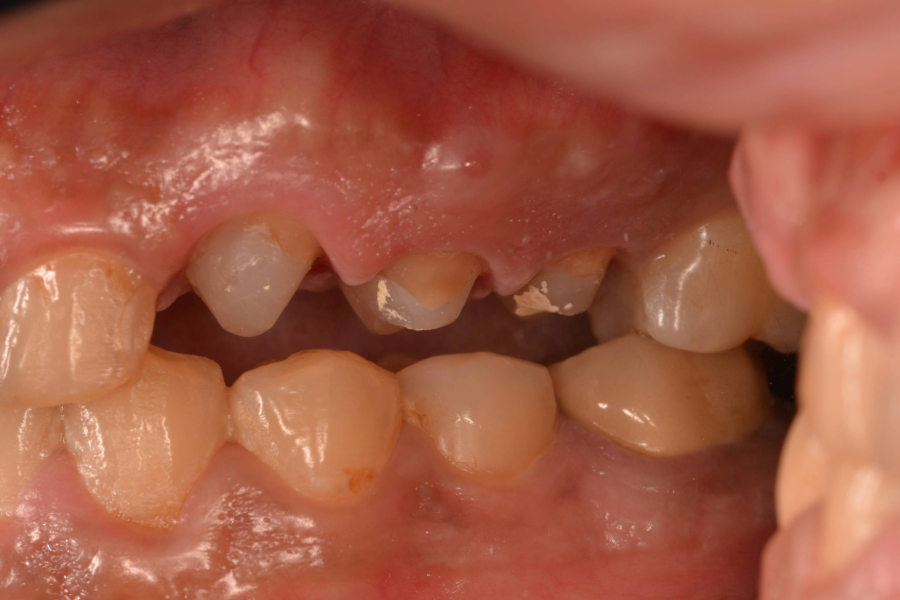 قبل تركيبات اسنان